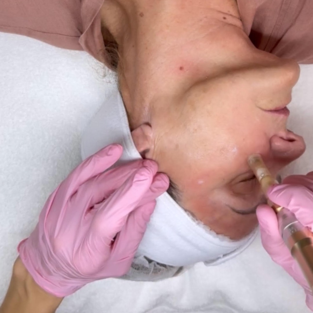 Polynucleotide (Salmon DNA, PDRN) For Skin Rejuvenation