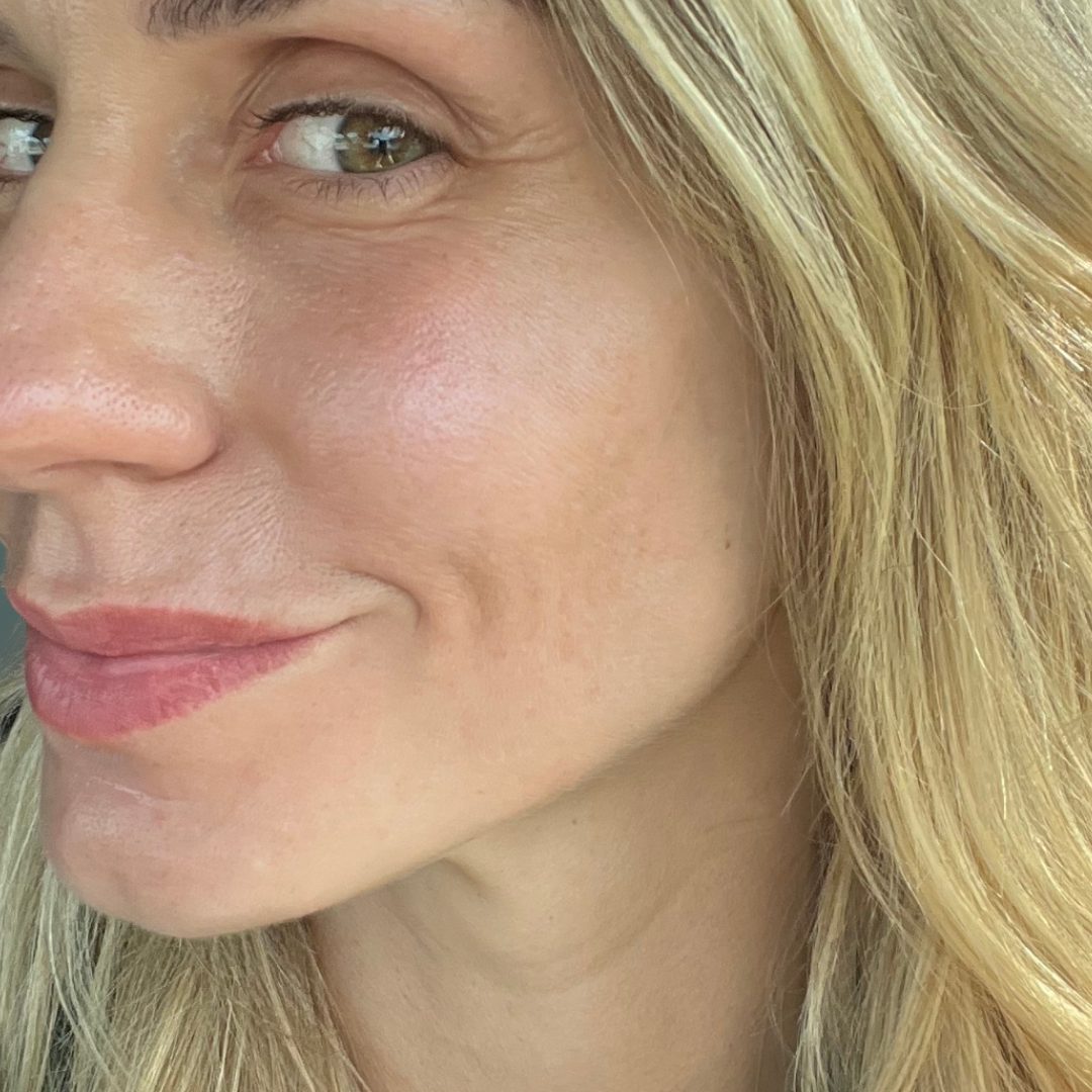 VI peel after - 2 peels (precision plus and advance)