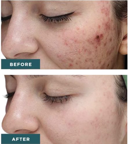 VI Peel Purify with Precision Plus