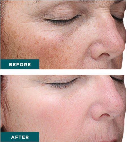 vi precision plus peel