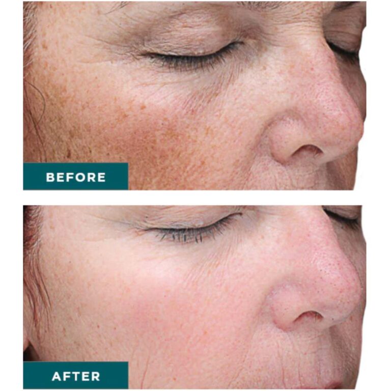 What is a Face and Body VI Chemical Peel? And How Does It Work?