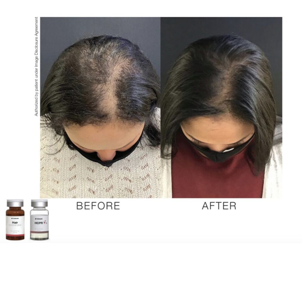 Toskanimed HCPR Hair Restoration: Advanced Non-Surgical Hair Loss Solution