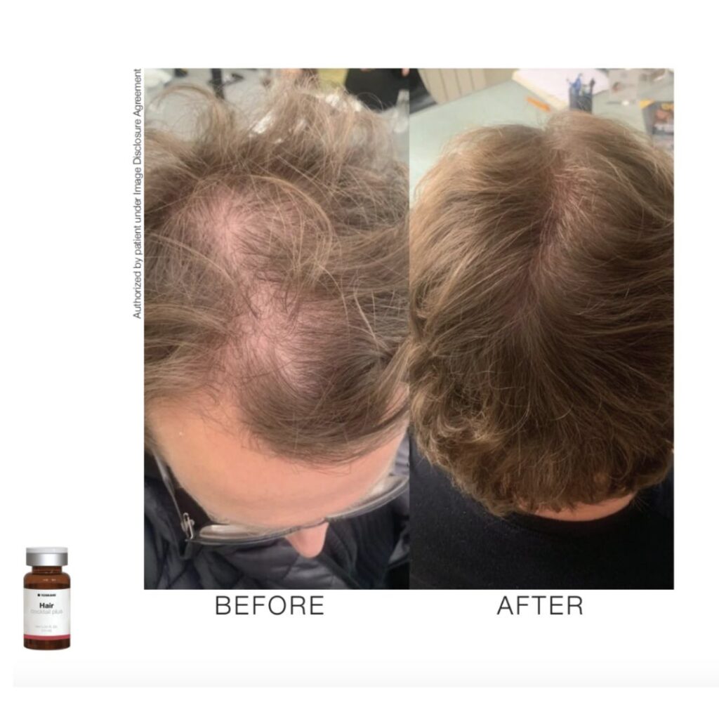 Toskanimed HCPR Hair Restoration: Advanced Non-Surgical Hair Loss Solution