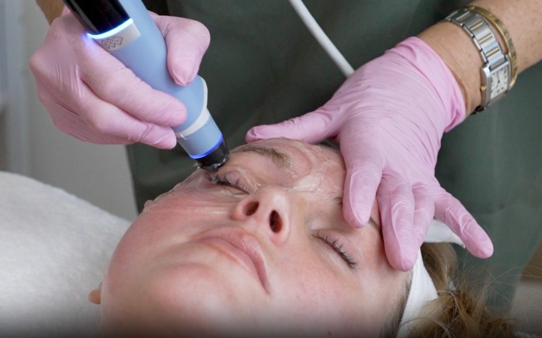 Facial Rejuvenation with BENEV Exosomes