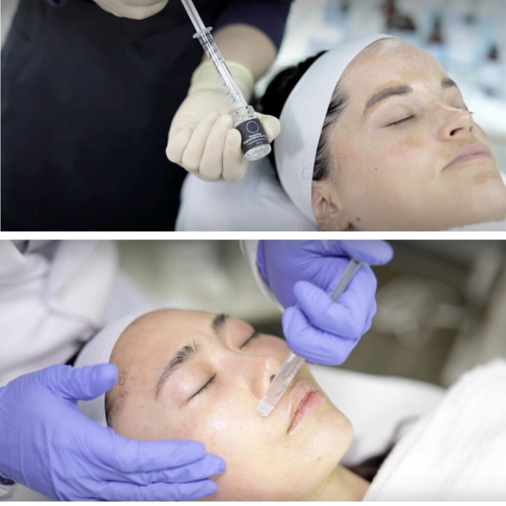 1770429519_Facial-Rejuvenation-with-BENEV-Exosomes-B Facial Rejuvenation with BENEV Exosomes
