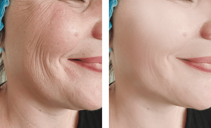 1770429612_PRP-Facial-Rejuvenation-C2 prp facial rejuvenation