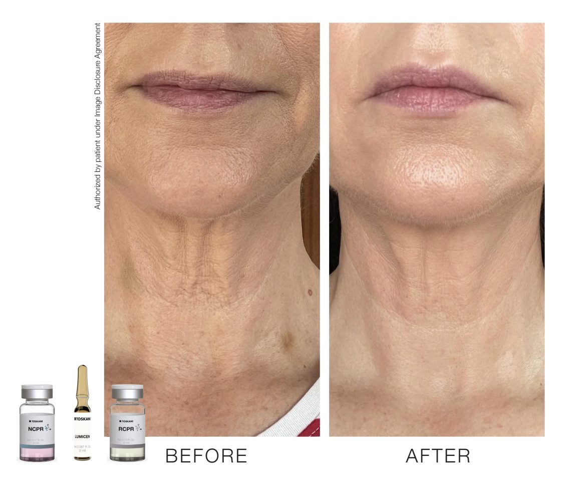 1770429682_img-lumicen-01 Facial Rejuvenation with TOSKANI MED Mesotherapy Before & After