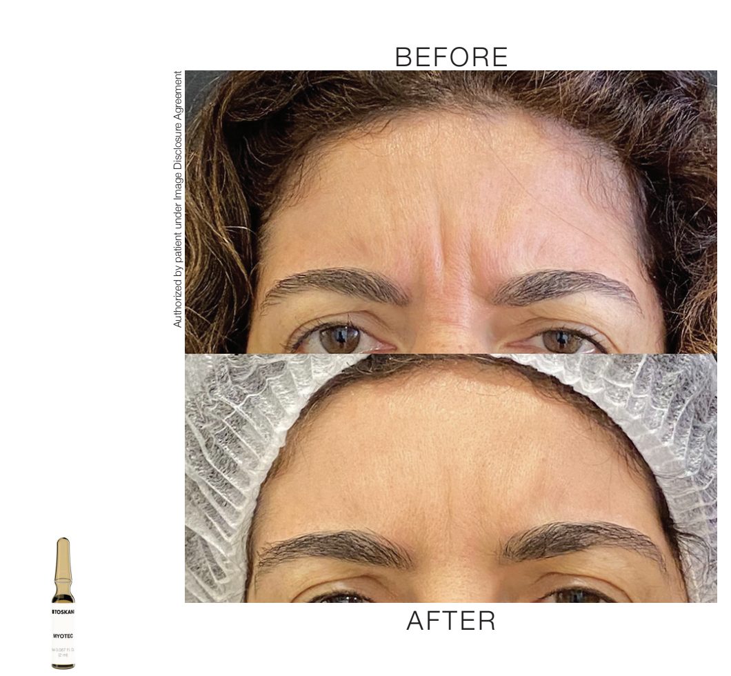 1770429686_myotec-ampoule-01 Before & Anfter Myotec Ampoule - minimizes fine lines and expression lines, particularly around the forehead, eyes, and lips,