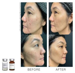 toskanimed mesotherapy clinical results