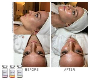 toskanimed mesotherapy clinical results