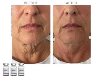 toskanimed mesotherapy clinical results