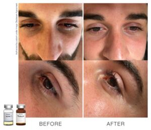 toskanimed mesotherapy clinical results