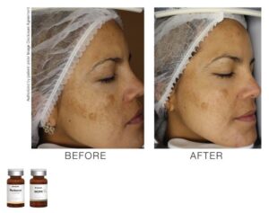 toskanimed mesotherapy clinical results