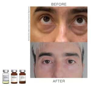 toskanimed mesotherapy clinical results