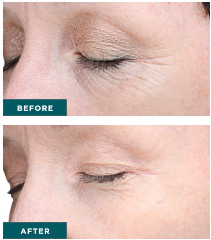 1770429734_vi-advance-peel vi advance peel