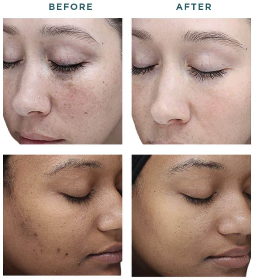 1770429748_vi-peel-orig-1 vi peel original