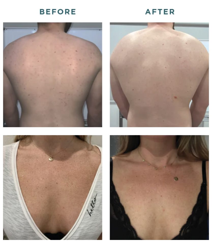 1770429753_vi-peel-body vi peel body