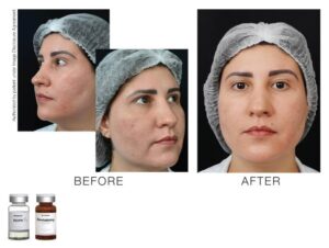 toskanimed mesotherapy clinical results