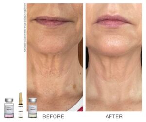 toskanimed mesotherapy clinical results