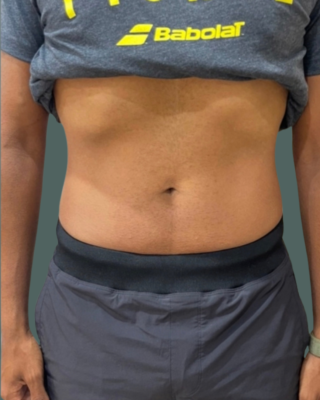 After Image: Emsculpt NEO – Male - front