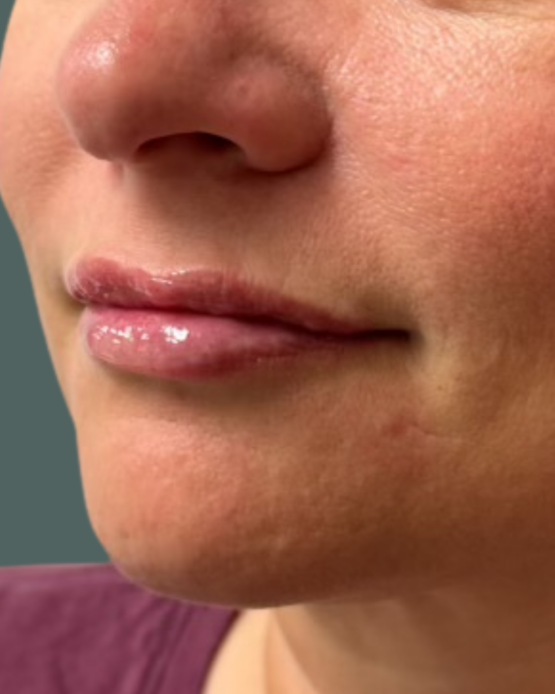 After Image: Lip Filler - left-front-oblique