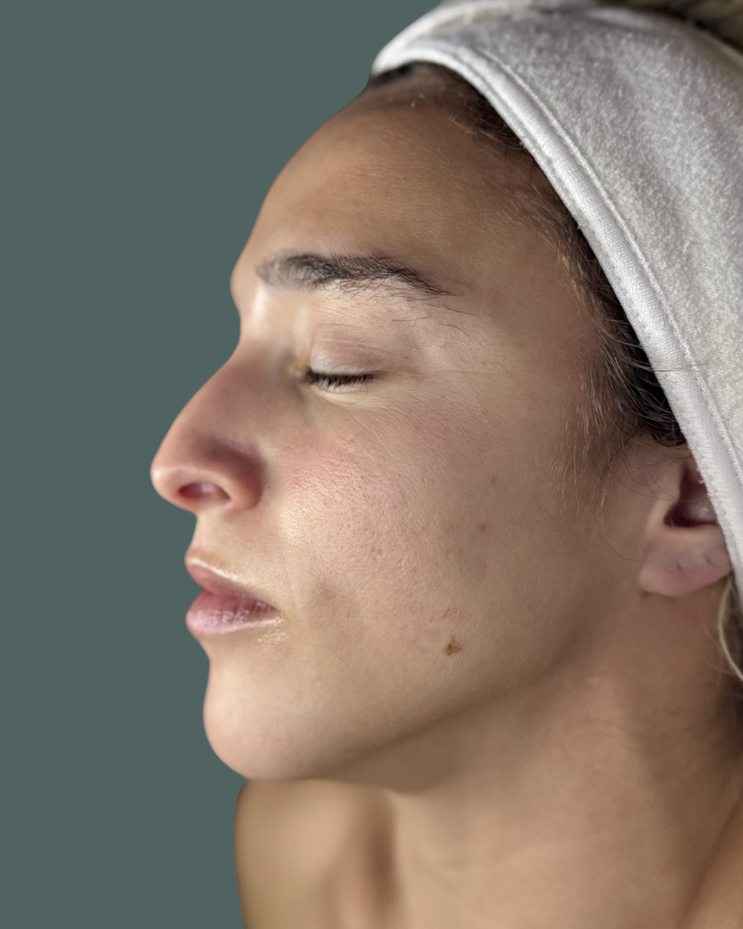 After Image: Acne Bootcamp - left-side