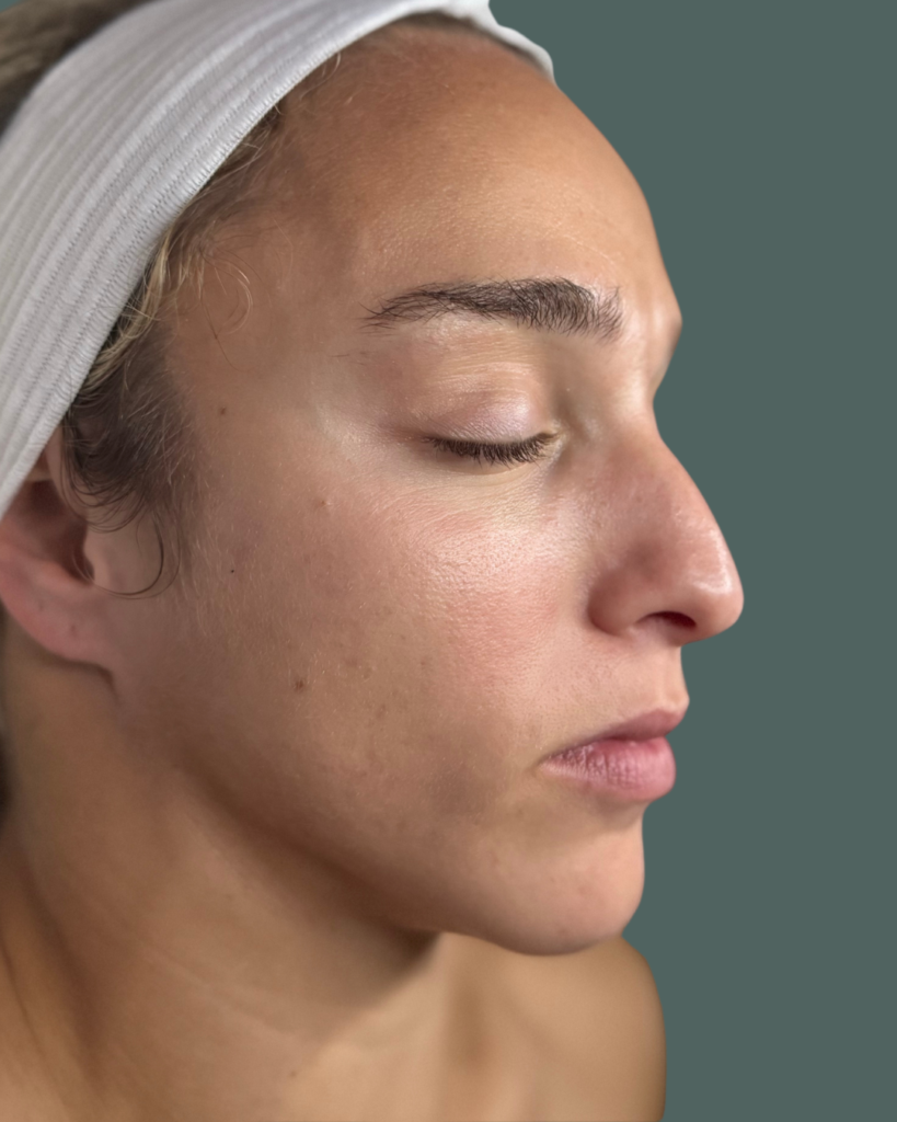 After Image: Acne Bootcamp - right-side