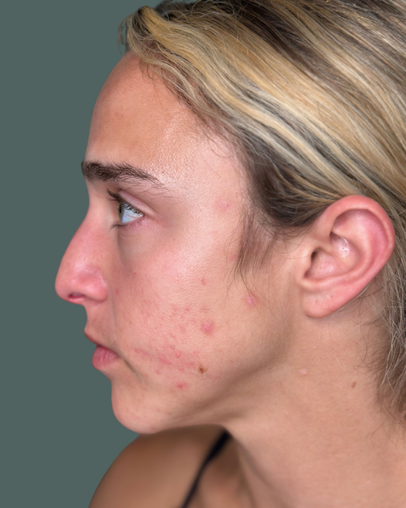 Before Image: Acne Bootcamp - left-side