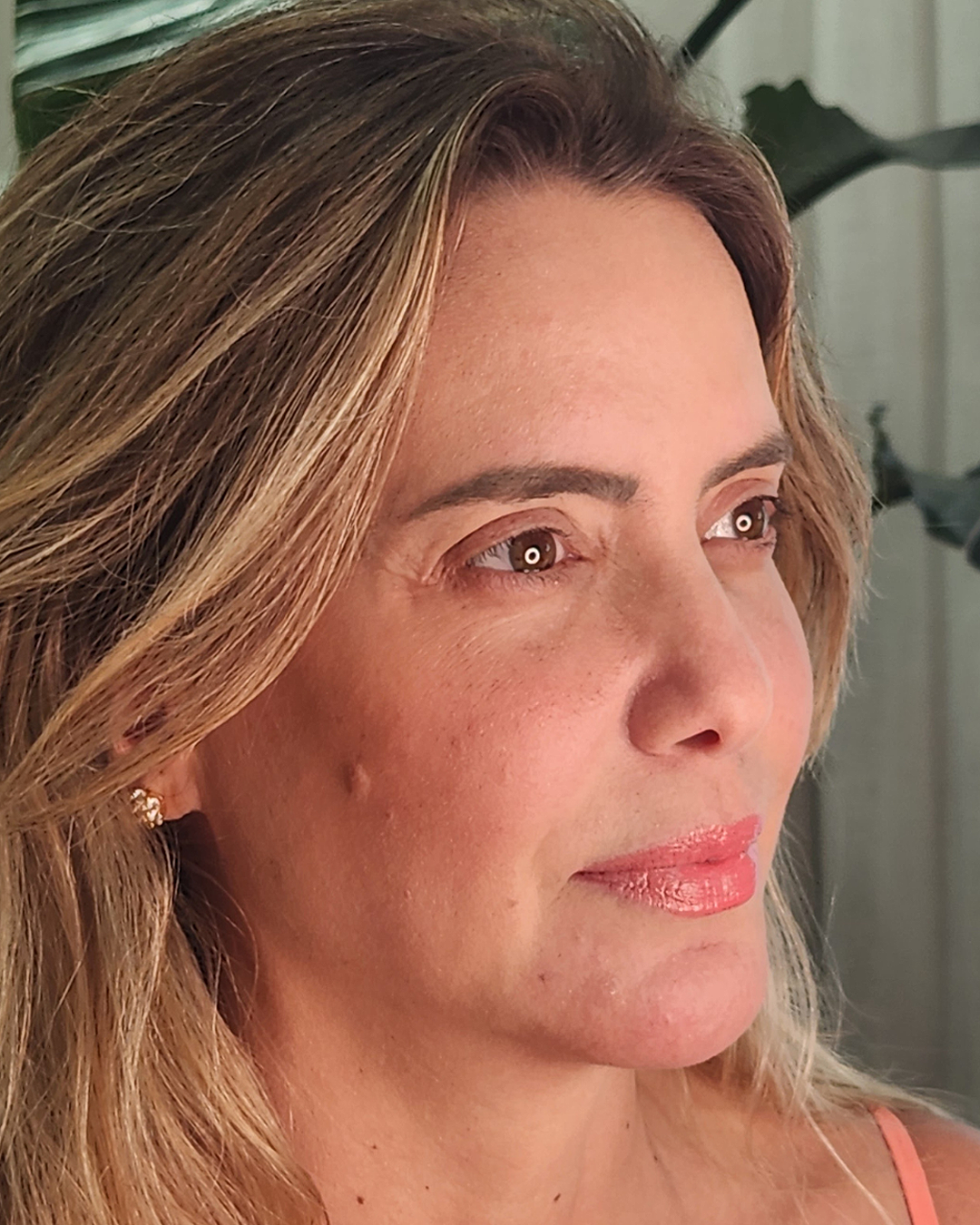 After Image: Facial Balancing – Sculptra + Dermal Filler - right-front-oblique