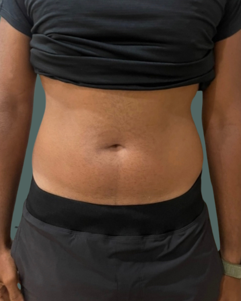 Before Image: Emsculpt NEO – Male - front