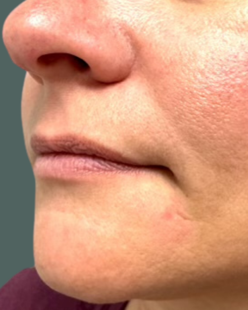 Before Image: Lip Filler - left-front-oblique