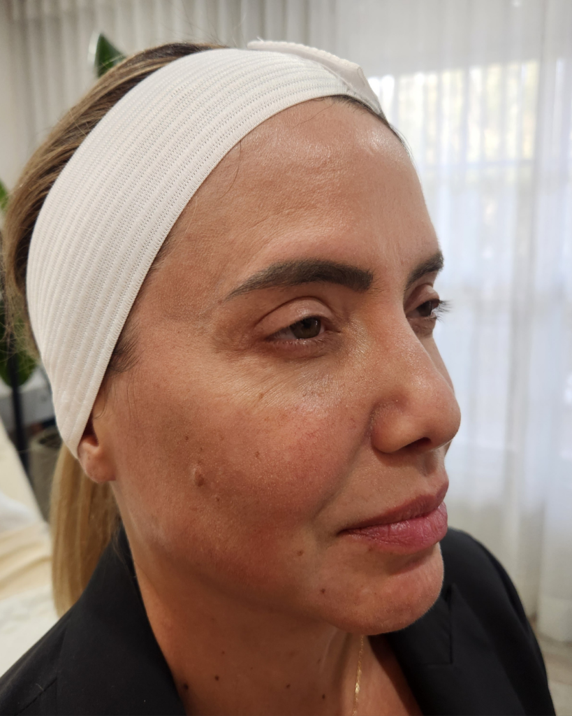 Before Image: Facial Balancing – Sculptra + Dermal Filler - right-front-oblique