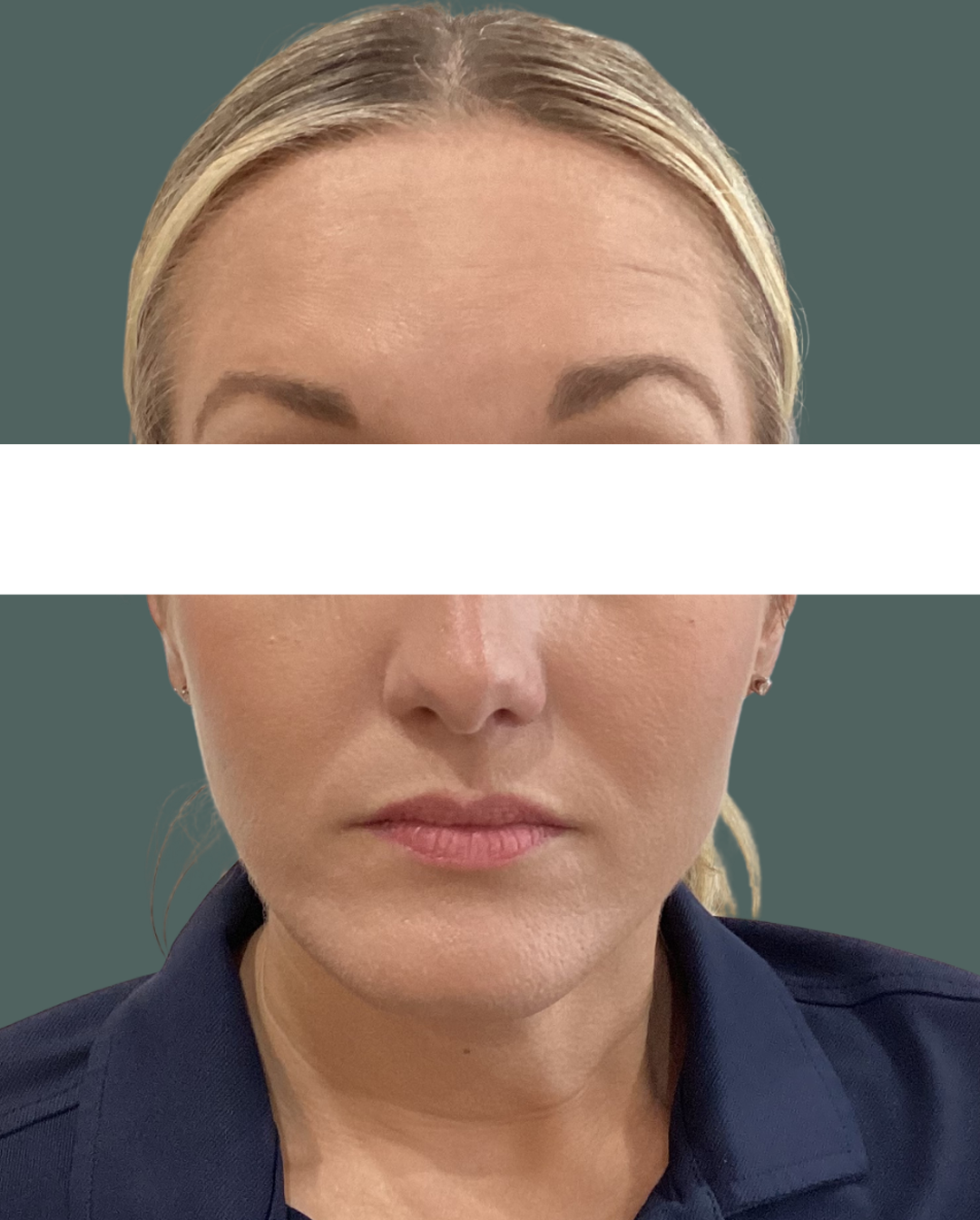 After Image: Botox - front