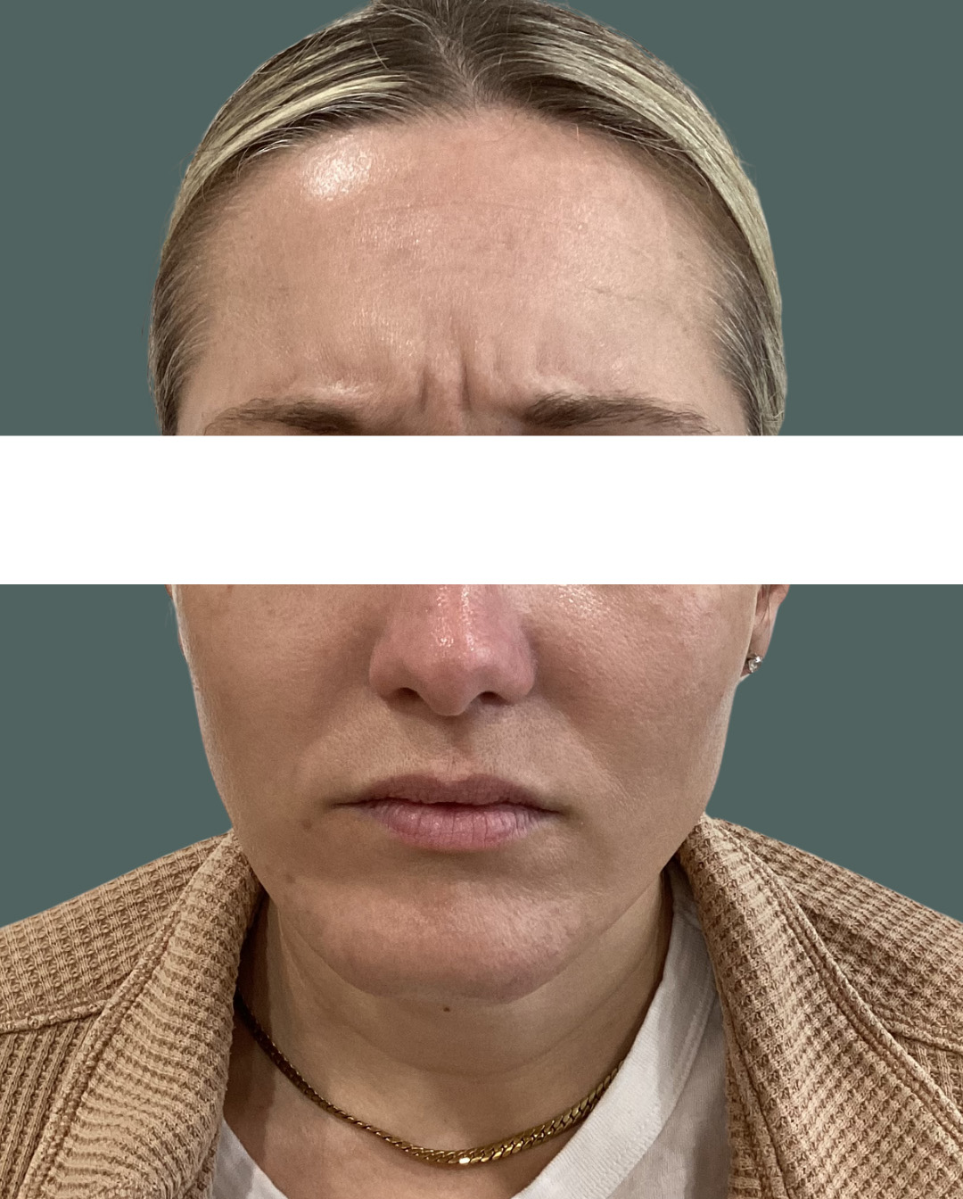 Before Image: Botox - front