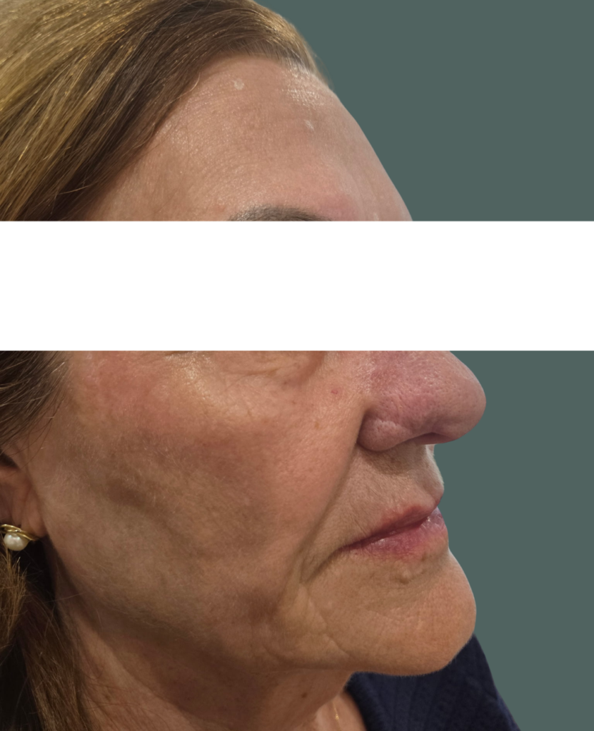 Before Image: Cheek Filler - right-front-oblique