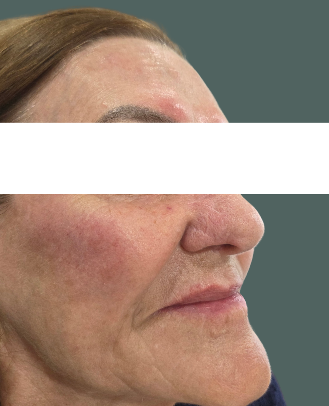 After Image: Cheek Filler - right-front-oblique