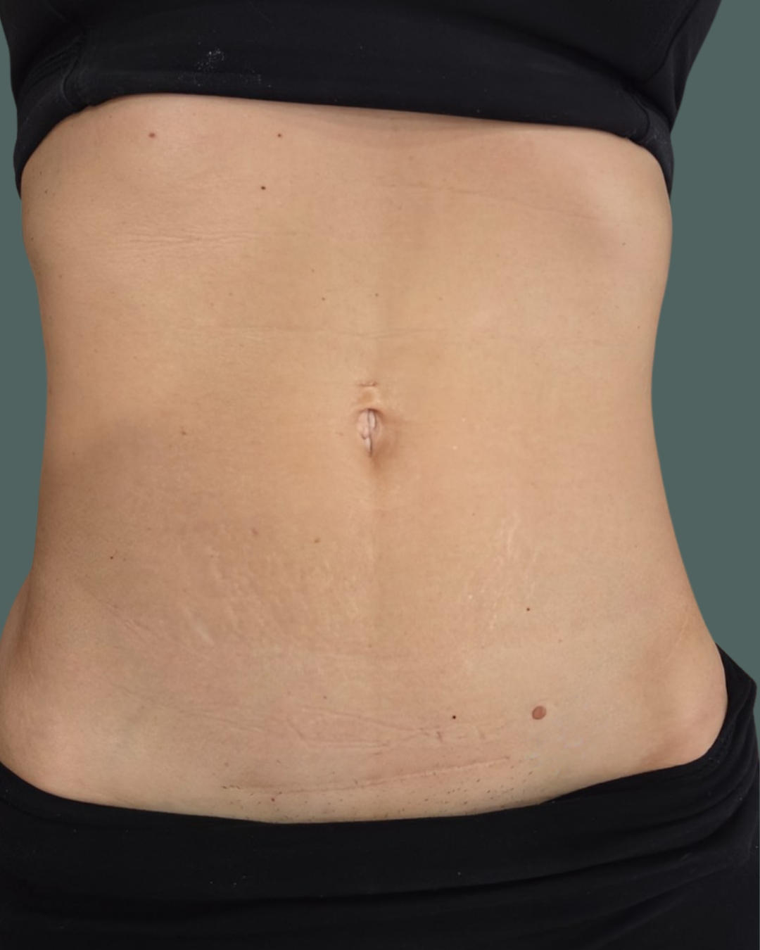 After Image: Emsculpt & RF Microneedling Loss & Emsculpt NEO sessions - front