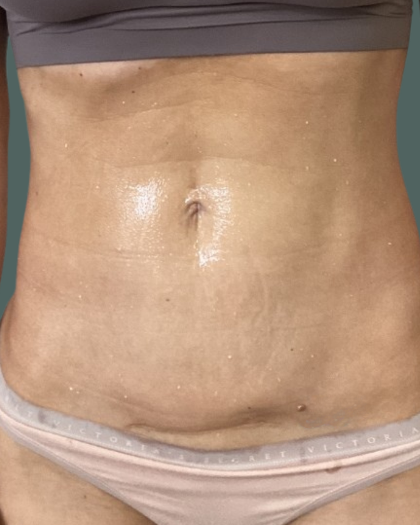 Before Image: Emsculpt & RF Microneedling Loss & Emsculpt NEO sessions - front