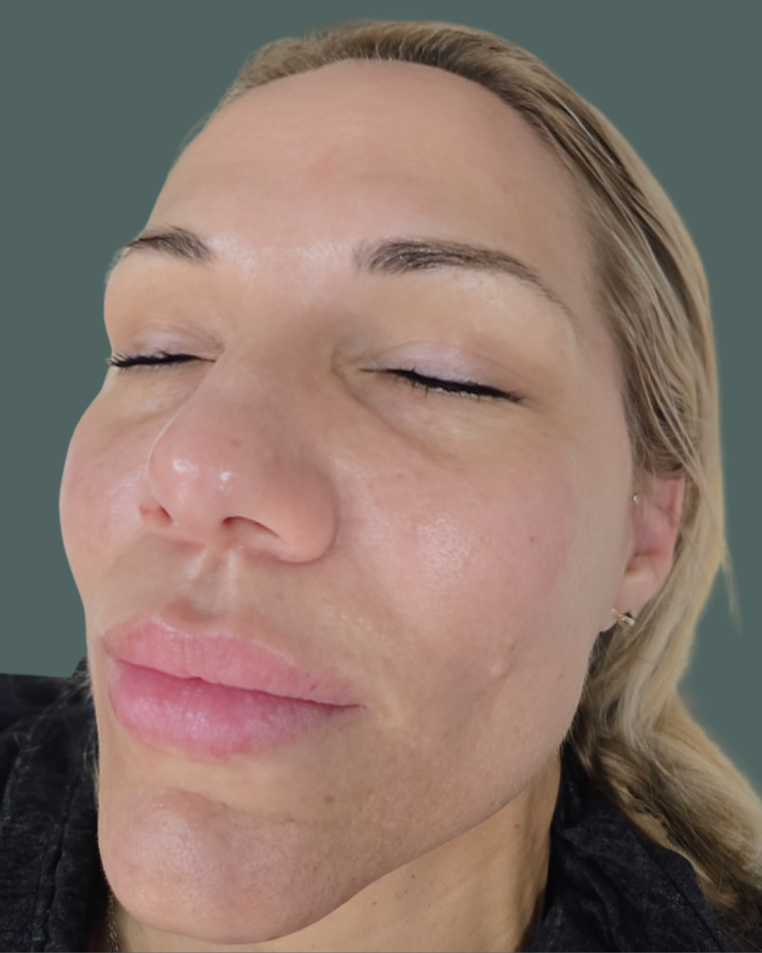 After Image: Exion RF Microneedling - left-front-oblique