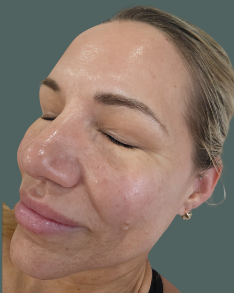 Before Image: Exion RF Microneedling - left-front-oblique