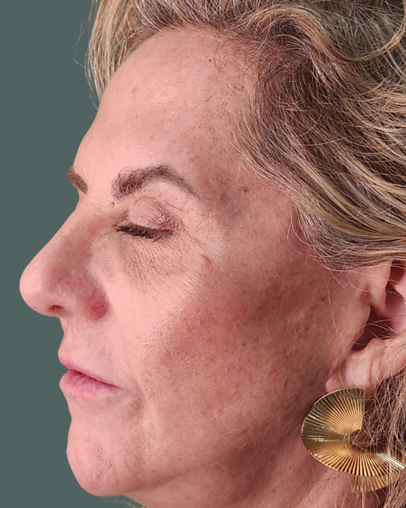 Before Image: LIP & CHEEK Filler - left-front-oblique