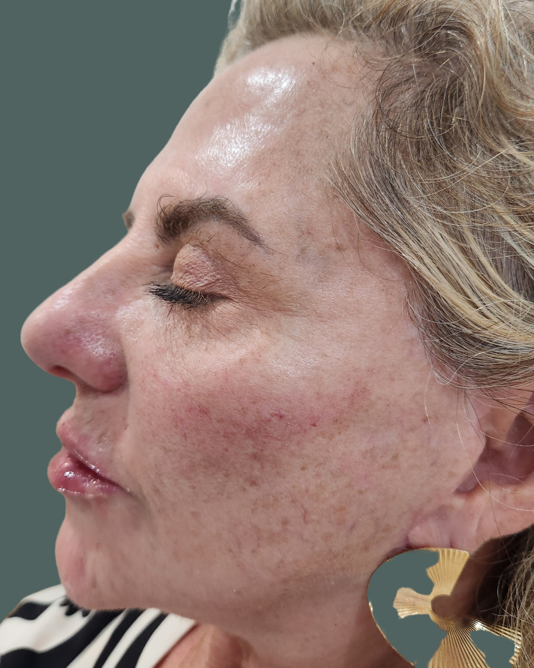 After Image: LIP & CHEEK Filler - left-front-oblique