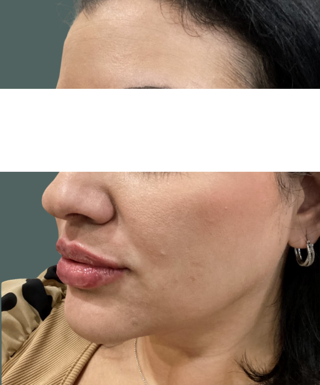 After Image: Lip Filler - left-front-oblique