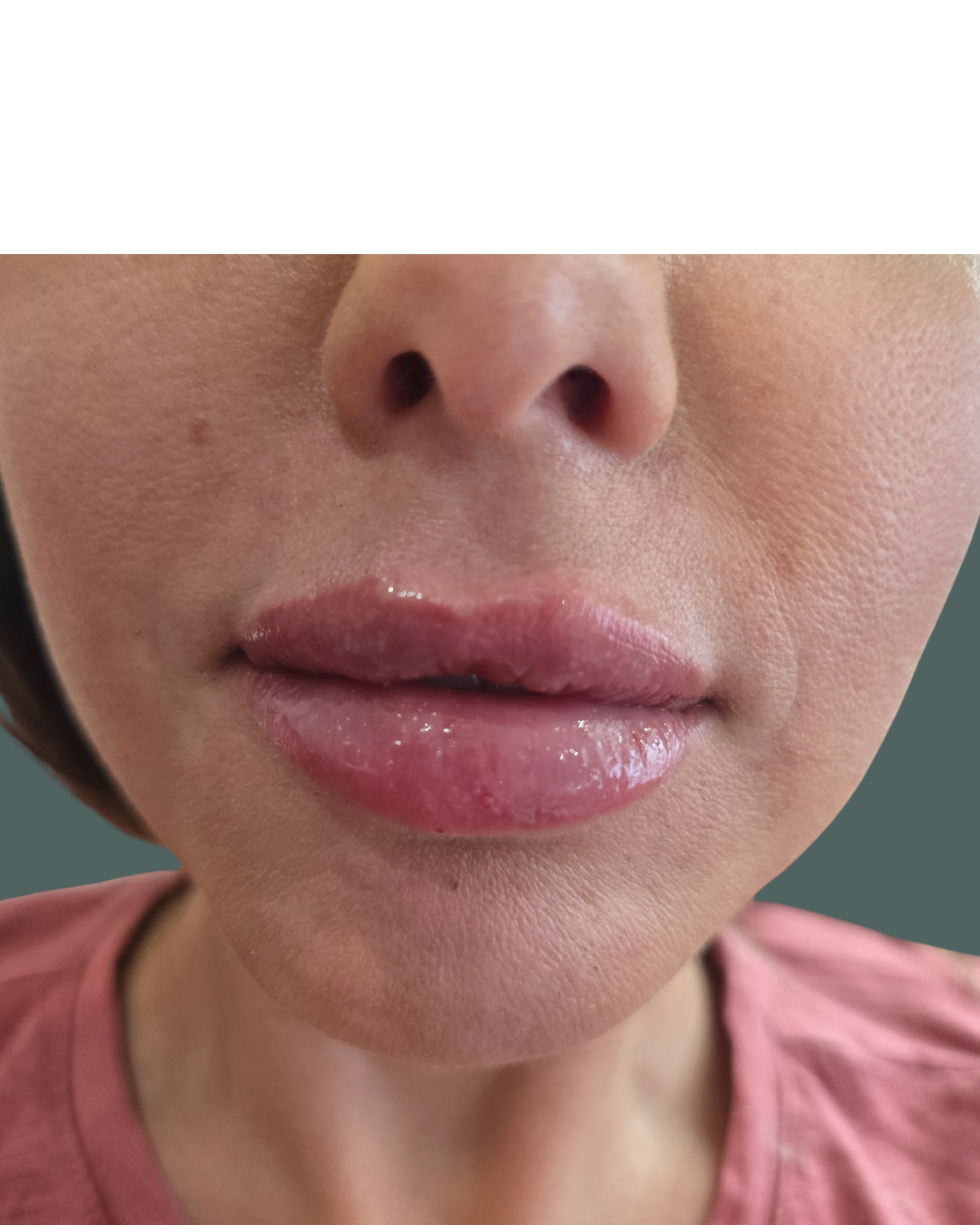 After Image: Lip Filler - front
