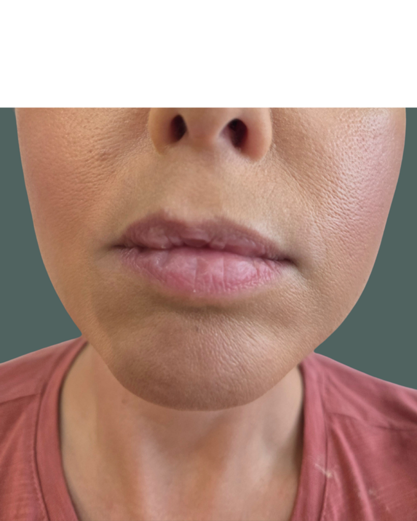 Before Image: Lip Filler - front