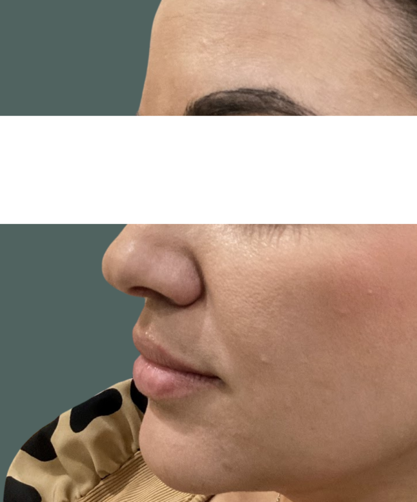 Before Image: Lip Filler - left-front-oblique