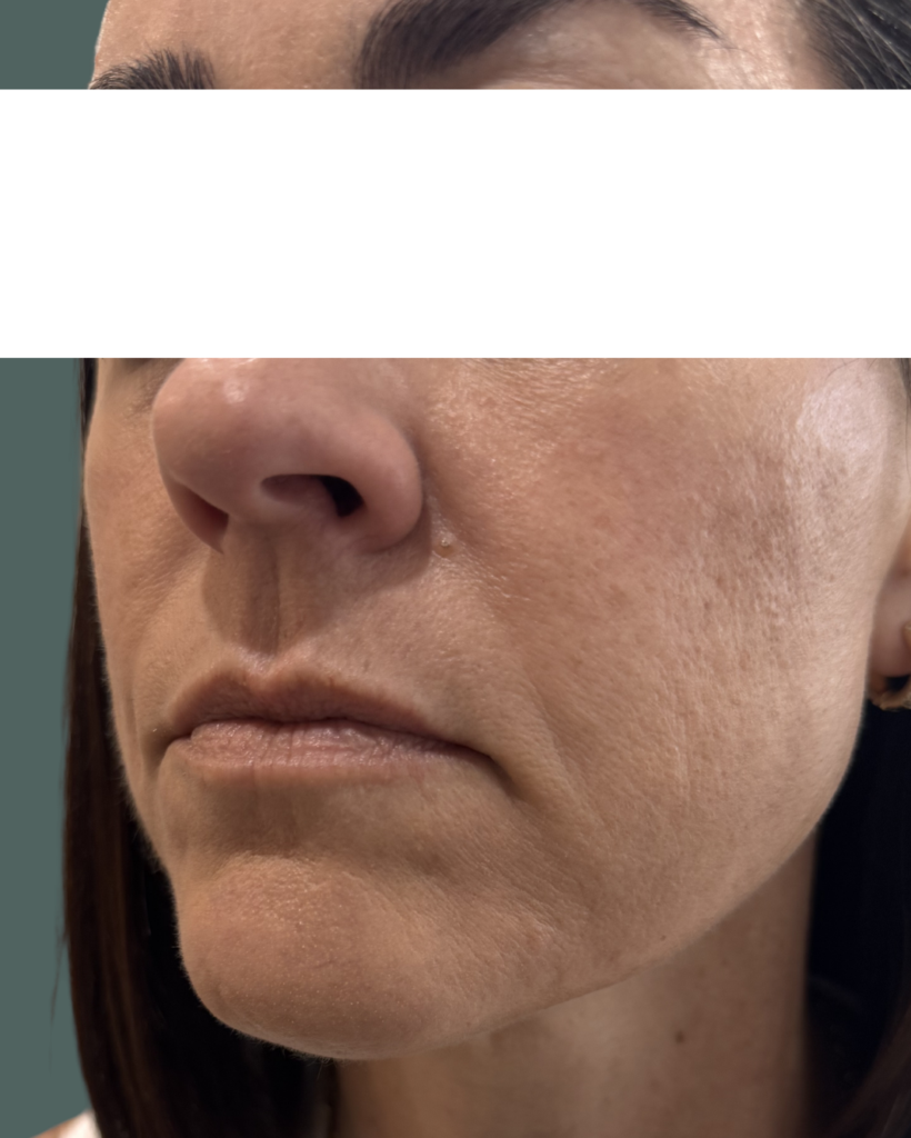 Before Image: Lip Filler - left-front-oblique
