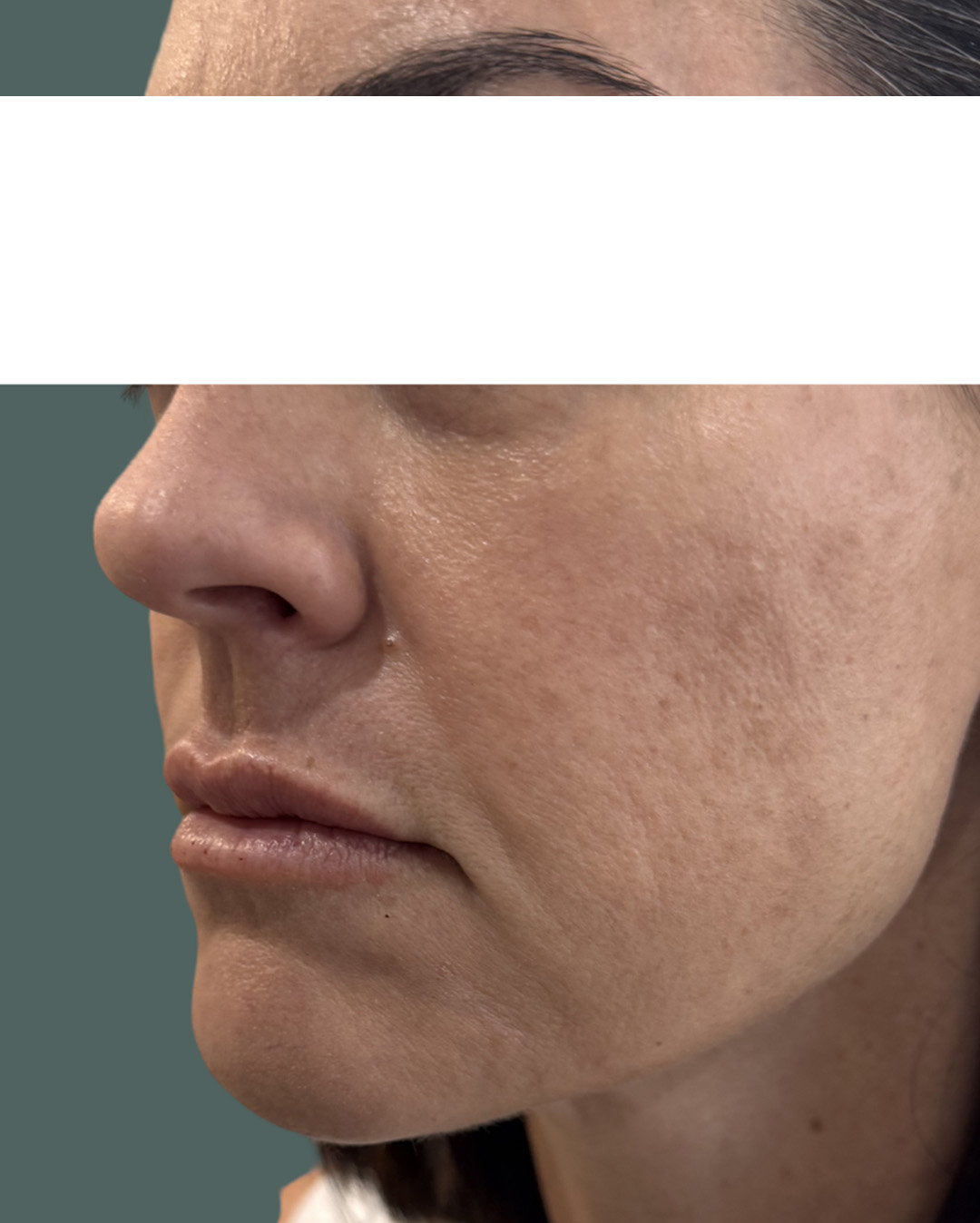 After Image: Lip Filler - left-front-oblique