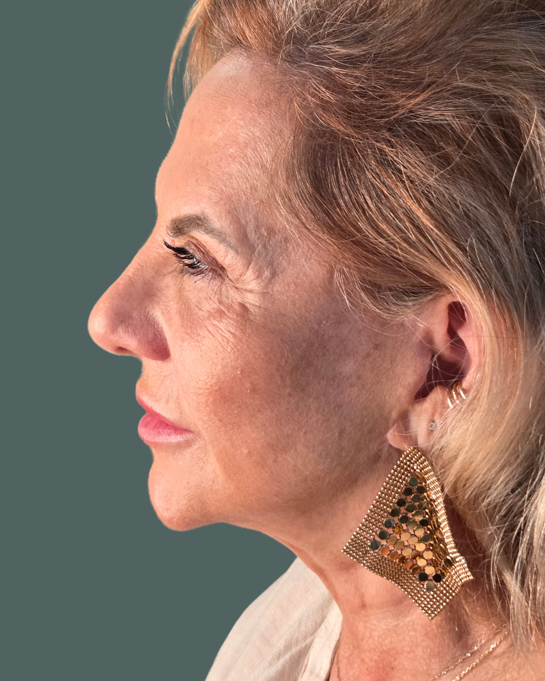 After Image: Microneedling with PRP, Dermal Filler & VI Peel - other
