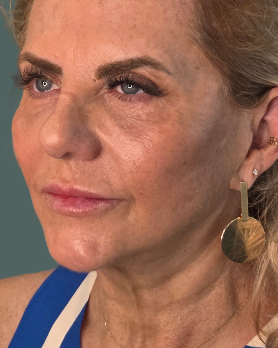 After Image: Microneedling with PRP, Dermal Filler & VI Peel - left-front-oblique